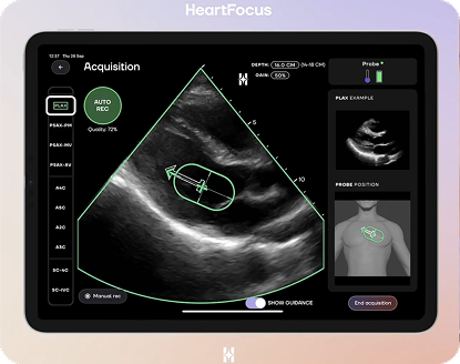 Interface HeartFocus pendant l'acquisition d'une échographie