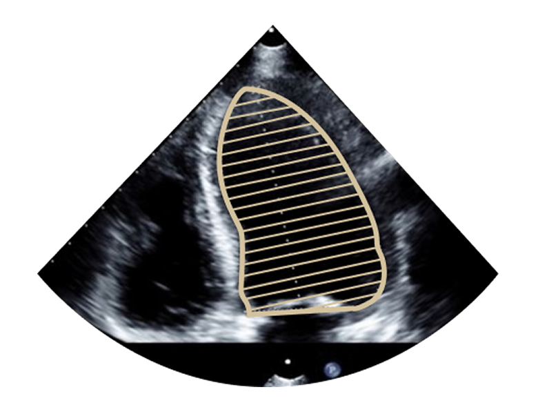 Image échographique avec le contour du ventricule gauche tracé