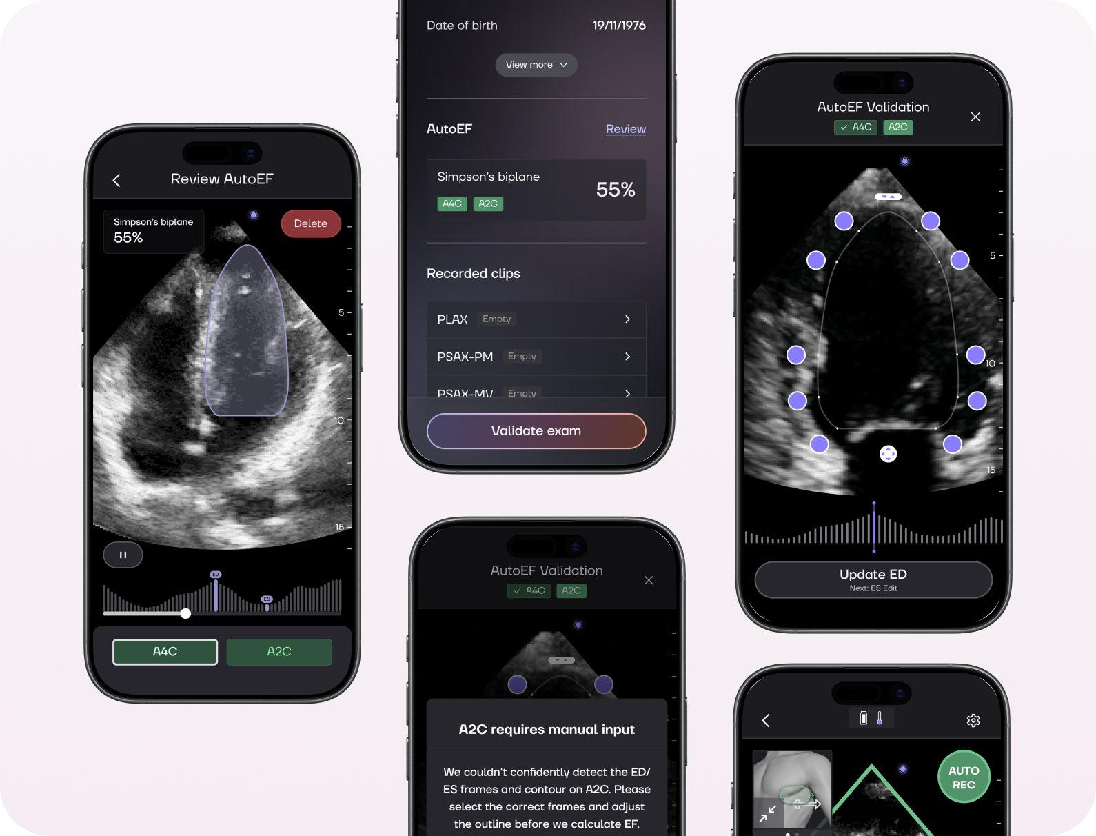 Aperçu de l'interface d'acquisition d'échographie cardiaque, avec contours en diastole et systole